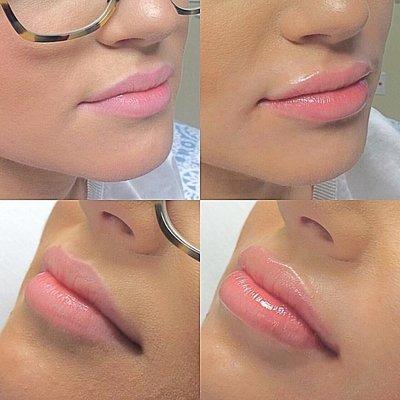 Beautiful lip enhancement using one syringe of Restylane Silk. Results are immediate and can last up to one year!