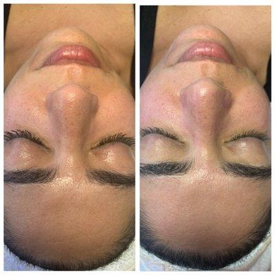 Skin Rejuvenation!