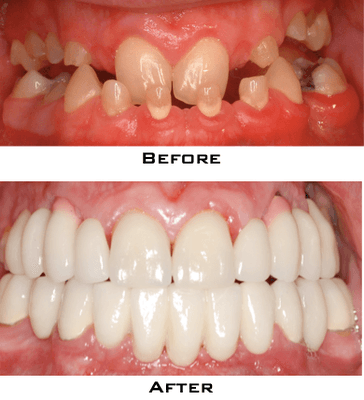 Full-mouth rehabilitation using implants, crowns and veneers used for full-mouth rehabilitation