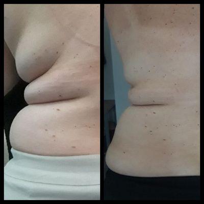 Lipo Cavitation before and after photo after 11 sessions.