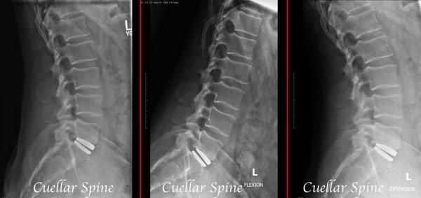 Cure chronic low back pain with total disc replacement!