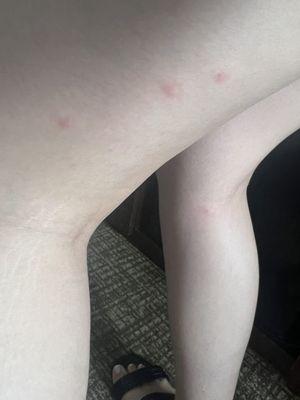 Bed bug bites