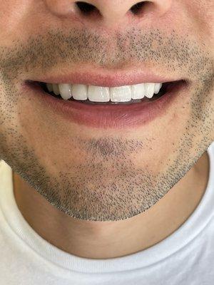 Porcelain Veneers