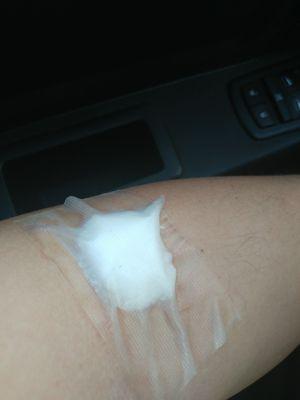 One of my arms were they messed up and couldn't get the IV