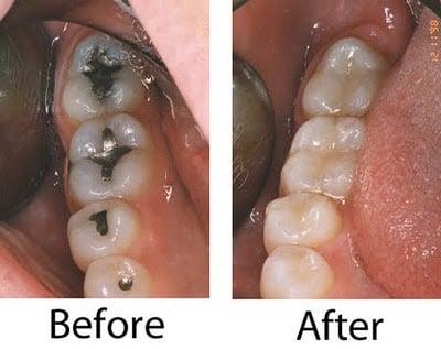 Let us help you safely remove the toxic amalgam fillings :)