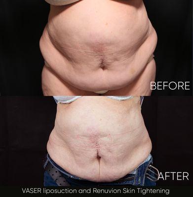 VASER liposuction and Renuvion skin tightening on stomach and flanks