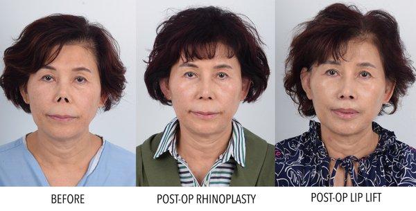 This patient received rhinoplasty and a lip lift.