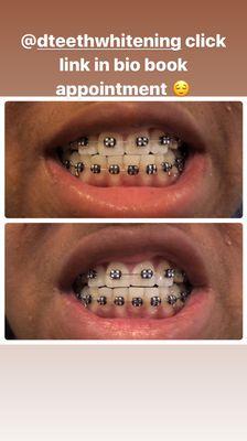 1st session teeth whitening