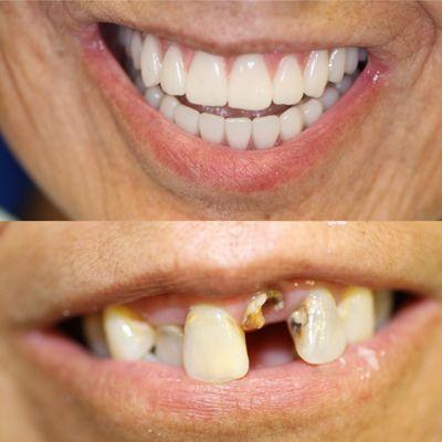 Patient With Severe Caries, gum disease & dry mouth,restored With Upper and Lower fixed Implant Zirconia Bridges.