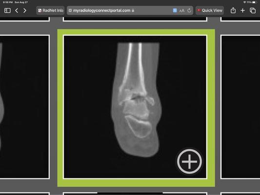 Left ankle CT image that RadNet had not released to my doctor.