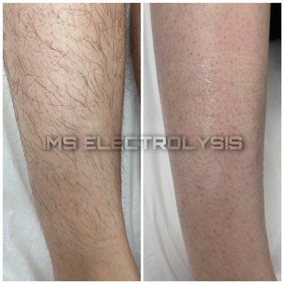 Electrolysis hair removal