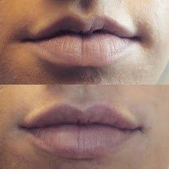 Subtle, Natural Lip Enhancement with injectable filler Refyne