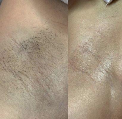 Before & after underarm wax