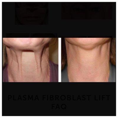 neck platysmal bands and wrinkles after plasma fibroblasting and botox treatment