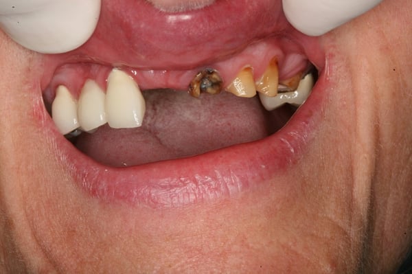 Before: Missing & Decayed Teeth