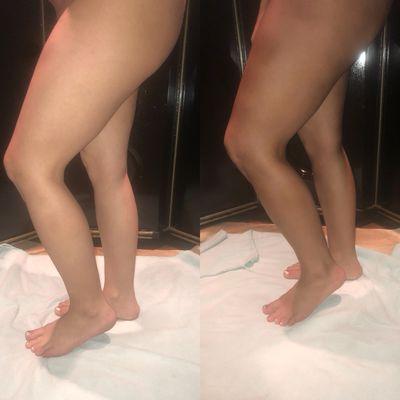 Before and after of clients legs