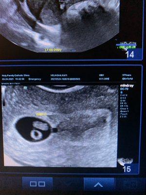 7 weeks pregnant and they were able to show me my baby's heartbeat