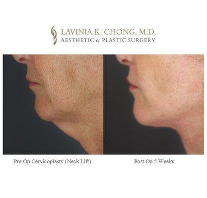 Cervicoplasty (Necklift), Facelift & Fat Transfer to resolve volume loss & jowls. Call Newport Beach OC female plastic surgeon 949-644-1400!