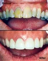 Revitalize a discolored, aging smile in just one visit!