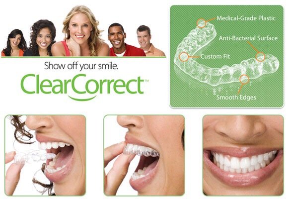 Save $1500 on orthodontic clear aligners! Call us today.