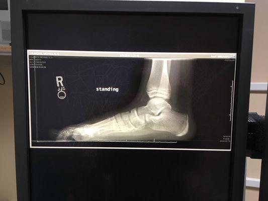 Small foot fracture :(