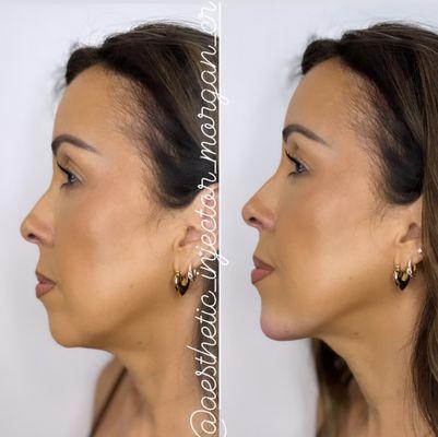 Chin augmentation before and after