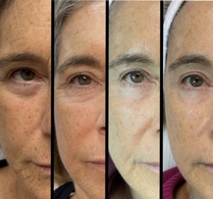 Laser Skin Rejuvenation