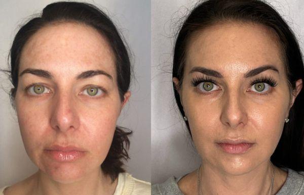 A full face correction with dermal filler by our talented injector Cory! Book with him today!