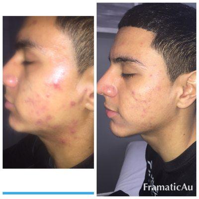 Before and after microneedling. 5th session. Acne reduced. Pores and acne scarring improved.