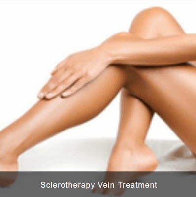 Sclerotherapy Vein Treatment