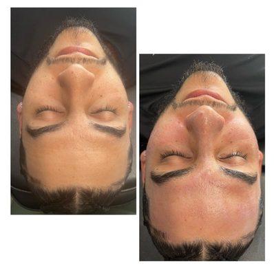 Before & After "Microneedling" Treatment #1. - Anna k.