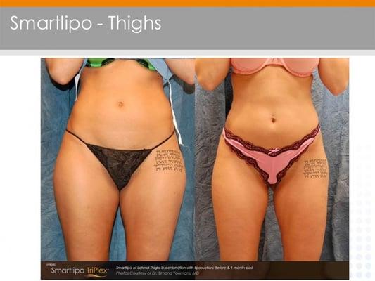 Smartlipo results