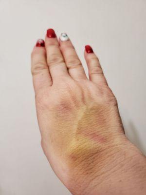 4 days after MRI with and without contrast -- this is my bruised and swollen left hand.