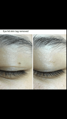 before & after skin tag removal