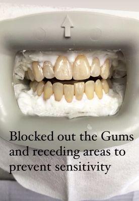 Blocking gums to prevent sensitivity