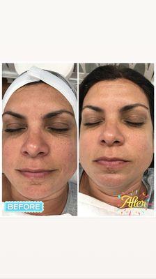 Microdermabrasion and oxygen facial combination!