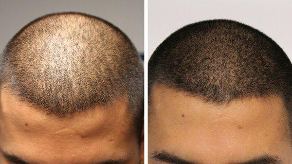 Before and After. Men's Filler Treatment