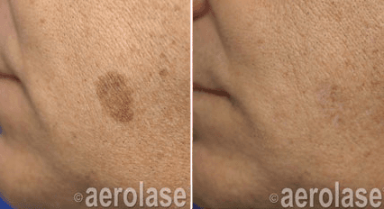 Age spot treated with Aerolase Neo.