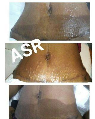 Stretch mark treatment!