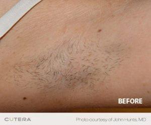 Laser Hair Removal Before