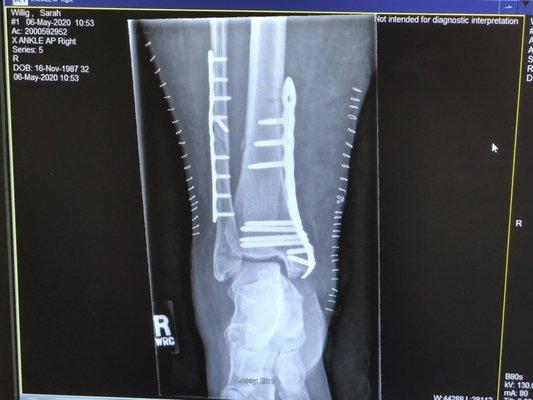 My broken ankle, post-surgery.