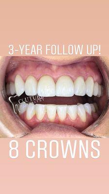 3-Year Follow up on 8 Crowns.  Consistently great results!