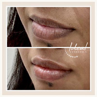 Lip filler immediately before & after