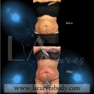 Body contouring