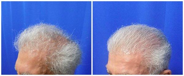 70-75 year old man treated with FUE/Neograft Hair Transplant procedure.