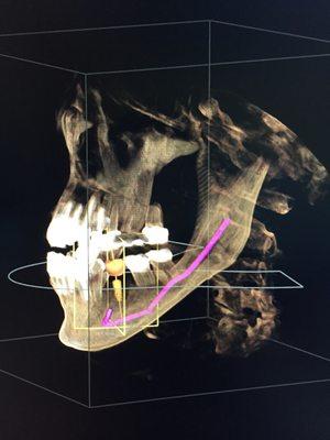 Our office offers 3D dental implant design and placement.