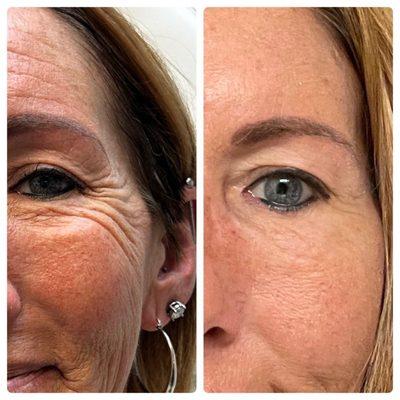 Botox injections to remove crows feet and forehead wrinkles and brow lift.