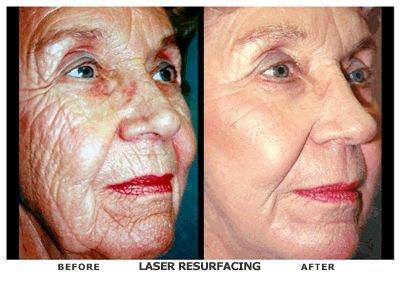 CO2 Skin Resurfacing Treatment improves surface texture and removes deep wrinkles.