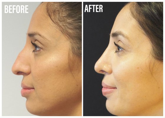 Rhinoplasty