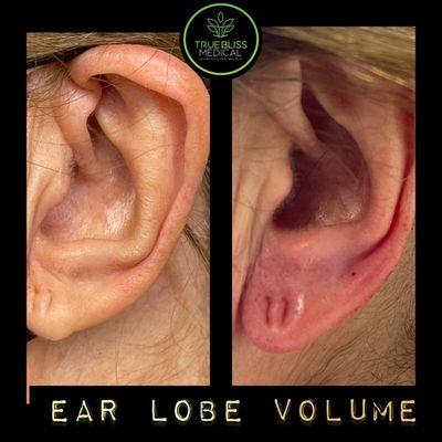 Ear lobe volume with dermal filler